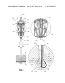 METHOD FOR SUTURING diagram and image