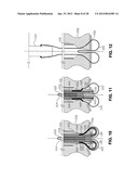 METHOD FOR SUTURING diagram and image