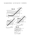 METHOD FOR SUTURING diagram and image