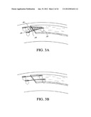 SYSTEM AND METHOD FOR ATTACHING SOFT TISSUE TO BONE diagram and image