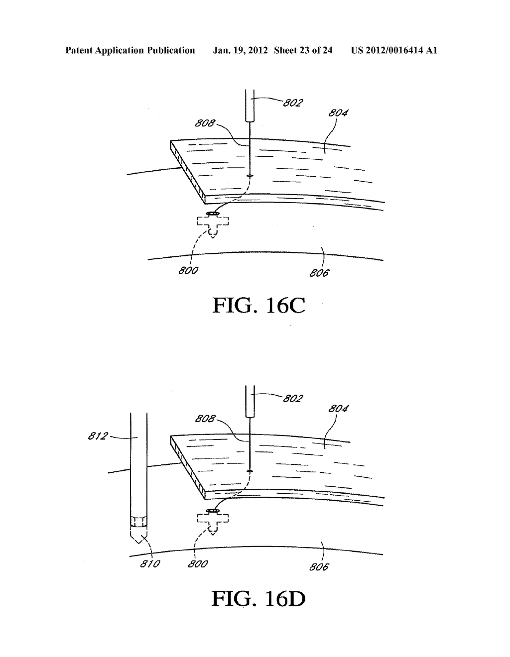 SYSTEM AND METHOD FOR ATTACHING SOFT TISSUE TO BONE - diagram, schematic, and image 24
