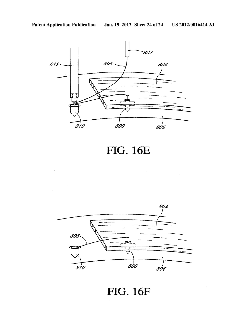 SYSTEM AND METHOD FOR ATTACHING SOFT TISSUE TO BONE - diagram, schematic, and image 25