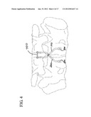 FLEXING LINKS FOR INTERVERTEBRAL STABILIZATION diagram and image