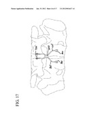 FLEXING LINKS FOR INTERVERTEBRAL STABILIZATION diagram and image