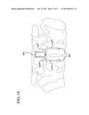 FLEXING LINKS FOR INTERVERTEBRAL STABILIZATION diagram and image