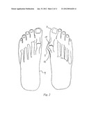 BUNION CORRECTION METHOD AND DEVICE diagram and image