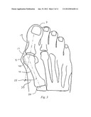 BUNION CORRECTION METHOD AND DEVICE diagram and image