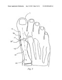 BUNION CORRECTION METHOD AND DEVICE diagram and image