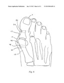 BUNION CORRECTION METHOD AND DEVICE diagram and image