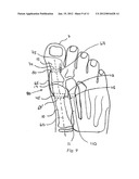 BUNION CORRECTION METHOD AND DEVICE diagram and image