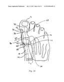 BUNION CORRECTION METHOD AND DEVICE diagram and image