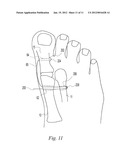 BUNION CORRECTION METHOD AND DEVICE diagram and image