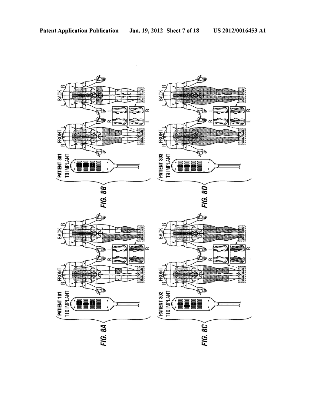 METHOD OF NEUROSTIMULATION OF DISTINCT NEURAL STRUCTURES USING SINGLE     PADDLE LEAD TO TREAT MULTIPLE PAIN LOCATIONS AND MULTI-COLUMN, MULTI-ROW     PADDLE LEAD FOR SUCH NEUROSTIMULATION - diagram, schematic, and image 08