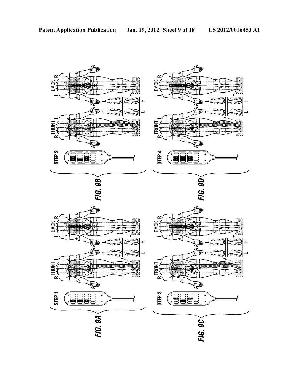 METHOD OF NEUROSTIMULATION OF DISTINCT NEURAL STRUCTURES USING SINGLE     PADDLE LEAD TO TREAT MULTIPLE PAIN LOCATIONS AND MULTI-COLUMN, MULTI-ROW     PADDLE LEAD FOR SUCH NEUROSTIMULATION - diagram, schematic, and image 10