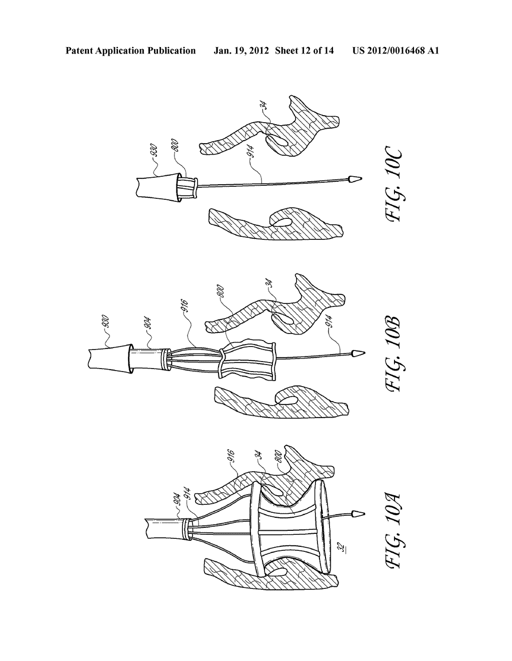 LOW CROSSING PROFILE DELIVERY CATHETER FOR CARDIOVASCULAR PROSTHETIC     IMPLANT - diagram, schematic, and image 13