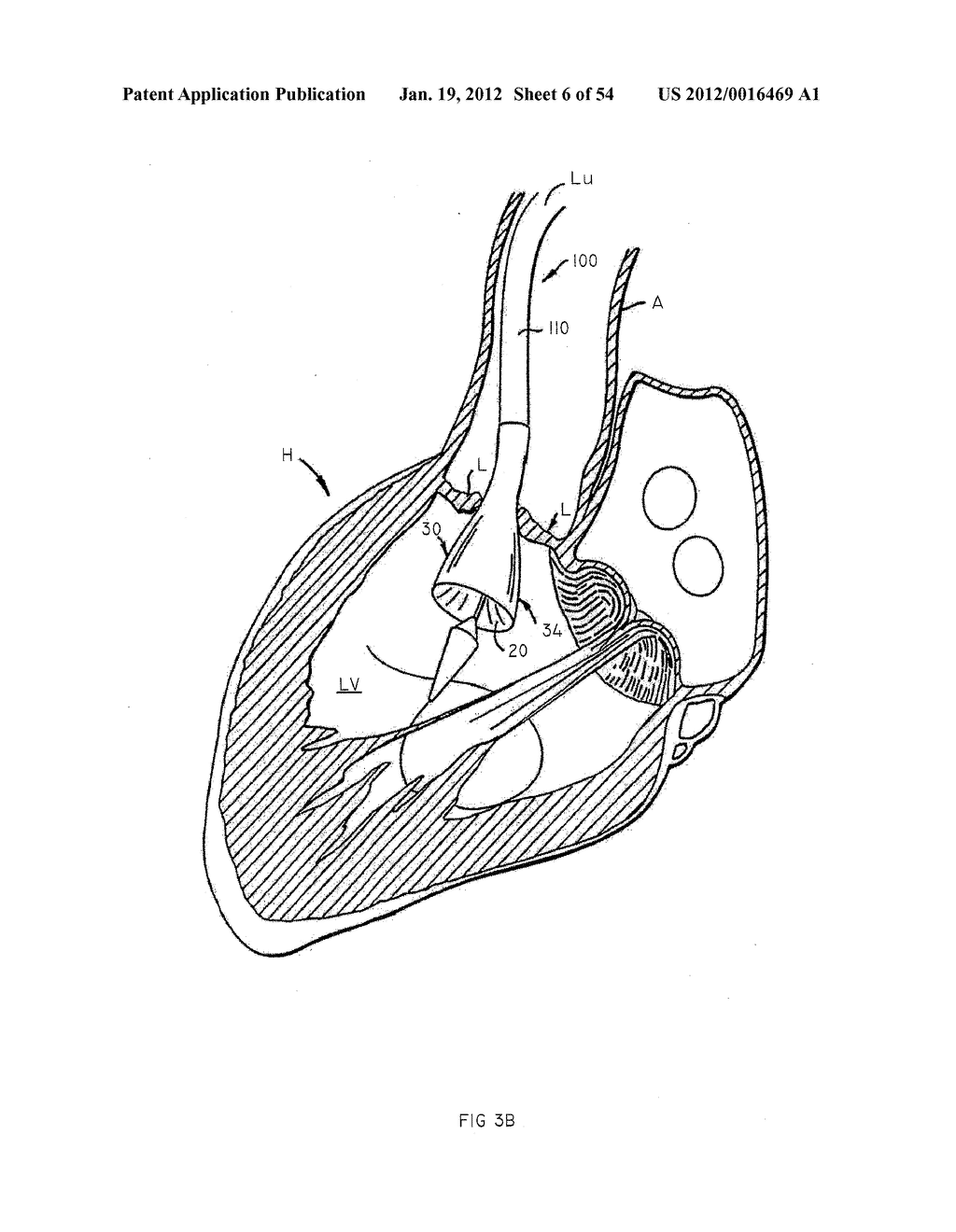 Methods and Apparatus for Endovascularly Replacing a Heart Valve - diagram, schematic, and image 07