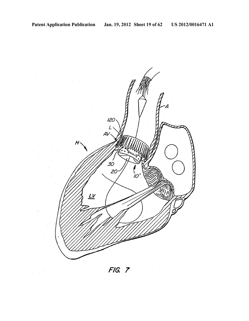 Low Profile Heart Valve and Delivery System - diagram, schematic, and image 20