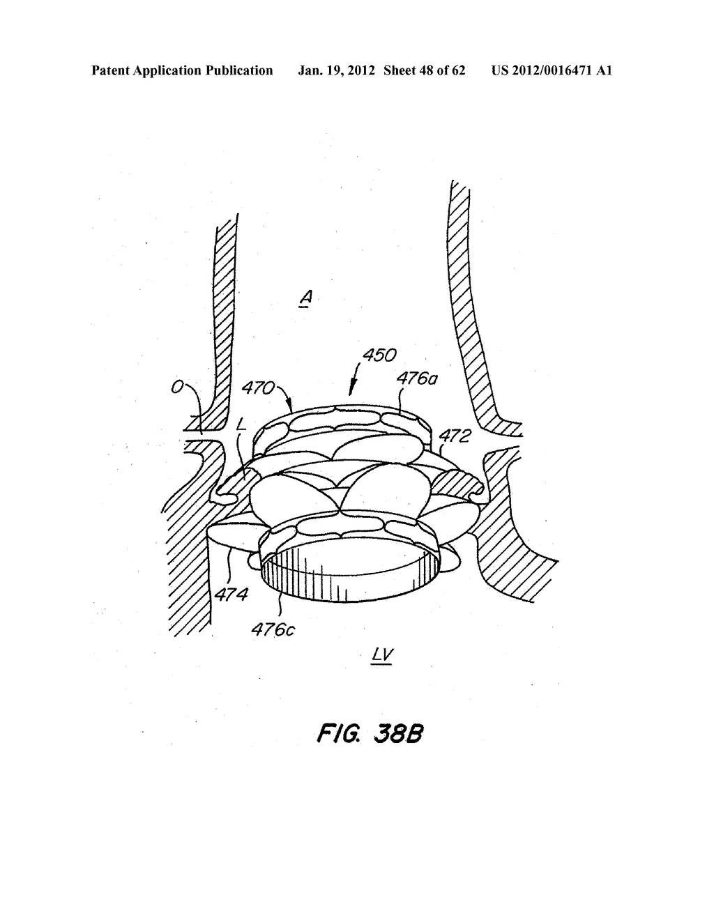 Low Profile Heart Valve and Delivery System - diagram, schematic, and image 49