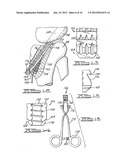 Apparatus and Method for Tibial Fixation of Soft Tissue diagram and image