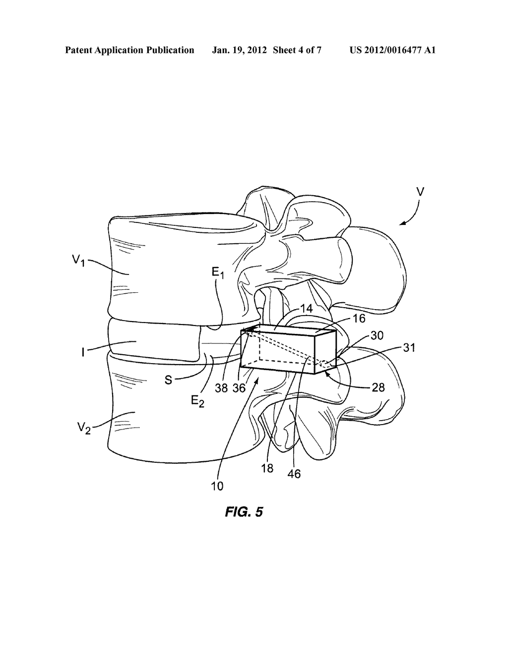 LOCKABLE IMPLANT AND METHOD OF USE - diagram, schematic, and image 05