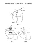 IMPLANT COMPONENTS AND METHODS diagram and image