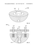 IMPLANT COMPONENTS AND METHODS diagram and image