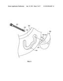 IMPLANT COMPONENTS AND METHODS diagram and image