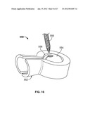 IMPLANT COMPONENTS AND METHODS diagram and image