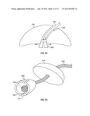 IMPLANT COMPONENTS AND METHODS diagram and image