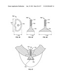 IMPLANT COMPONENTS AND METHODS diagram and image