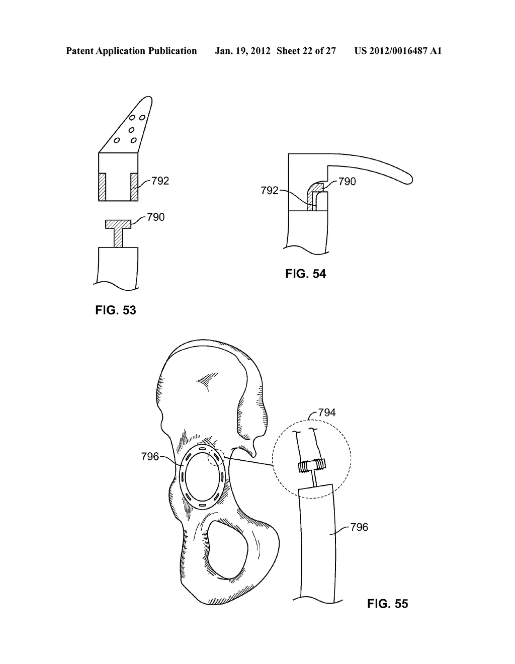 IMPLANT COMPONENTS AND METHODS - diagram, schematic, and image 23