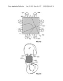 IMPLANT COMPONENTS AND METHODS diagram and image