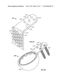 IMPLANT COMPONENTS AND METHODS diagram and image