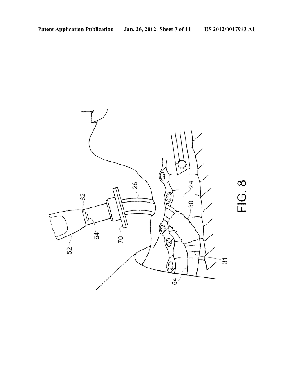 Tracheostomy Tube Loading Catheter - diagram, schematic, and image 08