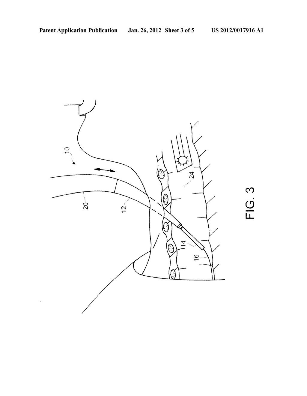 Dilator With Integrated Guiding Catheter - diagram, schematic, and image 04