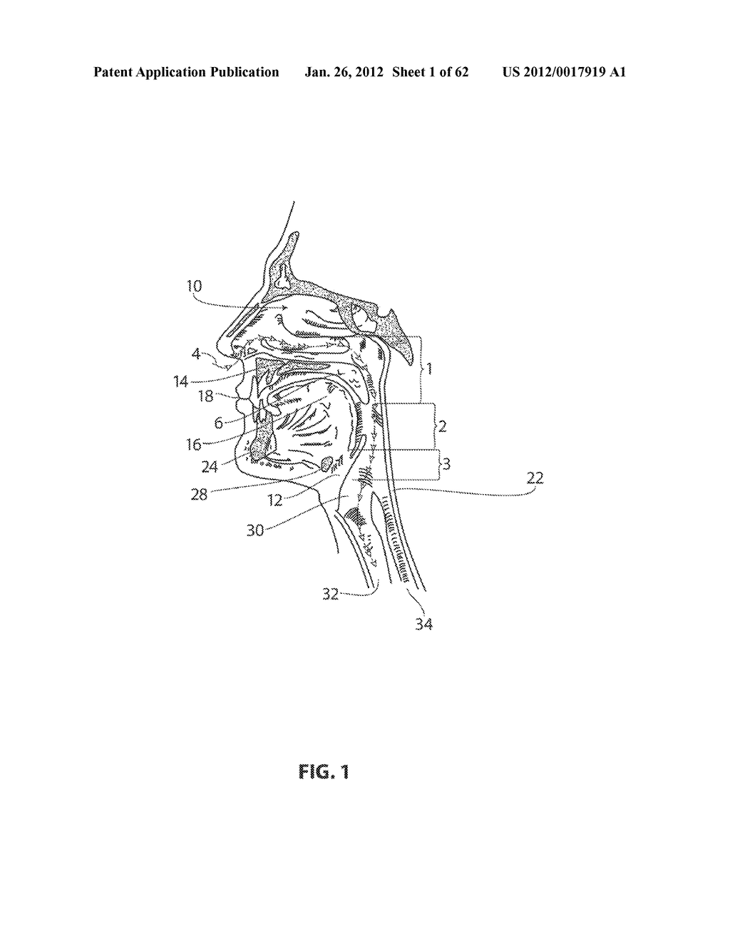 SYSTEMS AND METHODS FOR TREATMENT OF SLEEP APNEA - diagram, schematic, and image 02