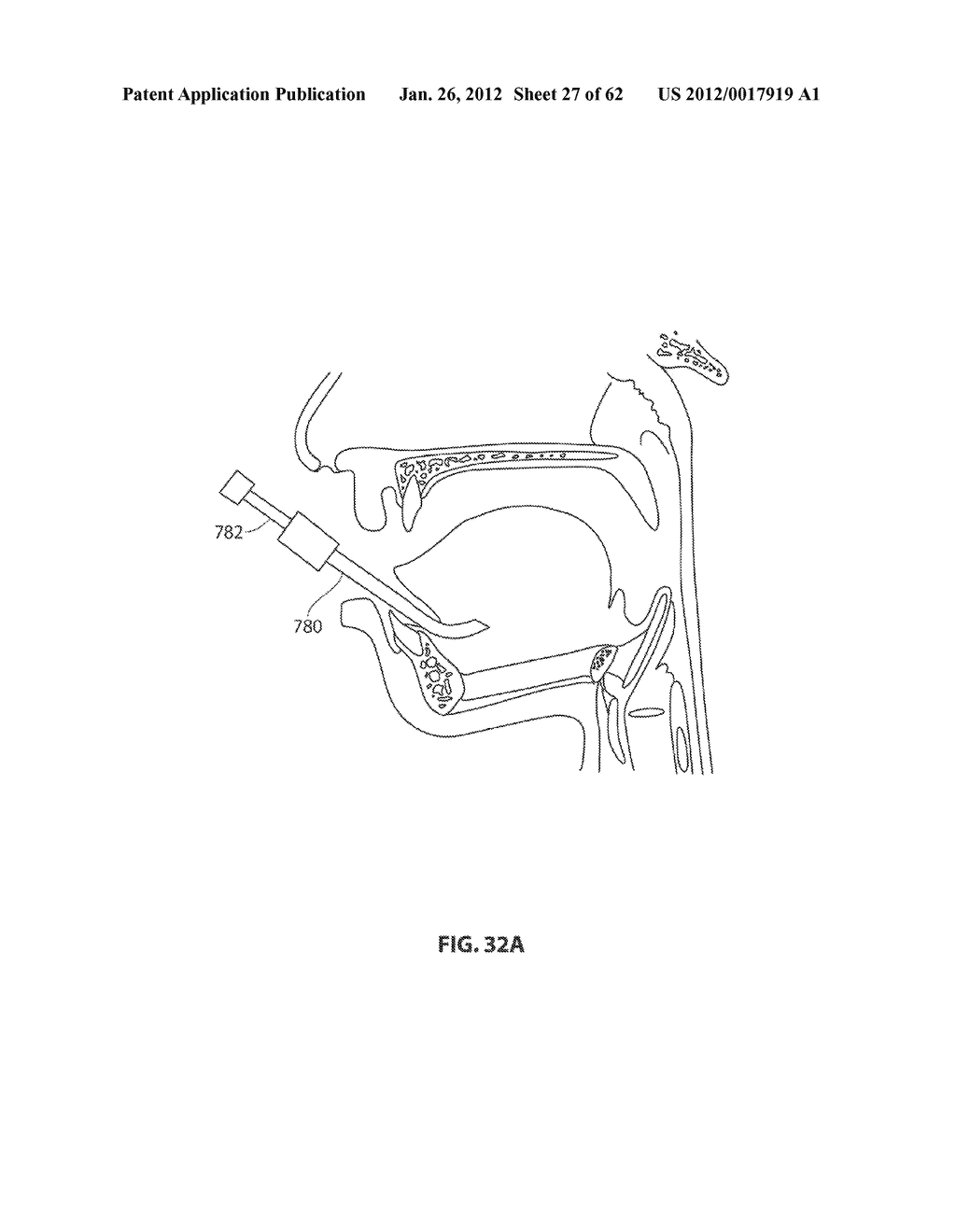 SYSTEMS AND METHODS FOR TREATMENT OF SLEEP APNEA - diagram, schematic, and image 28