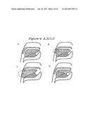 Method and Device for the Treatment of Obstructive Sleep Apnea and Snoring diagram and image