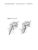 Method and Device for the Treatment of Obstructive Sleep Apnea and Snoring diagram and image