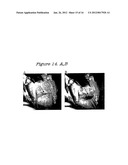 Method and Device for the Treatment of Obstructive Sleep Apnea and Snoring diagram and image