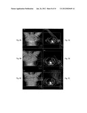 Intensity modulated arc therapy with continuous couch rotation/shift and     simultaneous cone beam imaging diagram and image