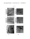 AUTOLOGOUS AND ALLOGENIC ADIPOSE-DERIVED STROMAL STEM CELL COMPOSITION FOR     TREATING FISTULAS diagram and image