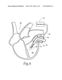 Method and Apparatus for Preventing Air Embolisms diagram and image