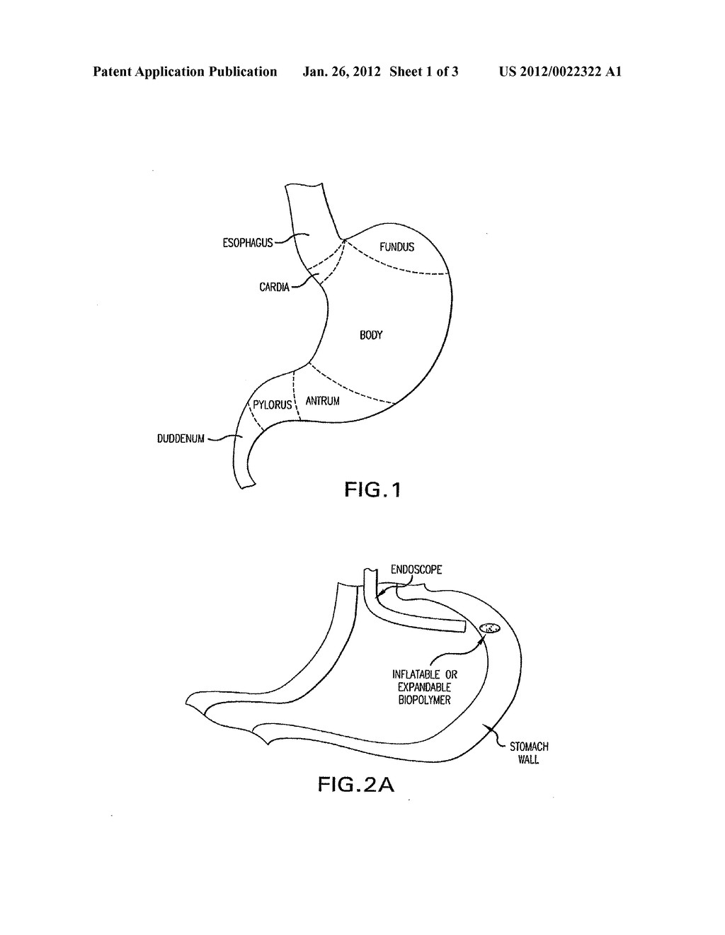 Methods and Devices for Treating Obesity - diagram, schematic, and image 02