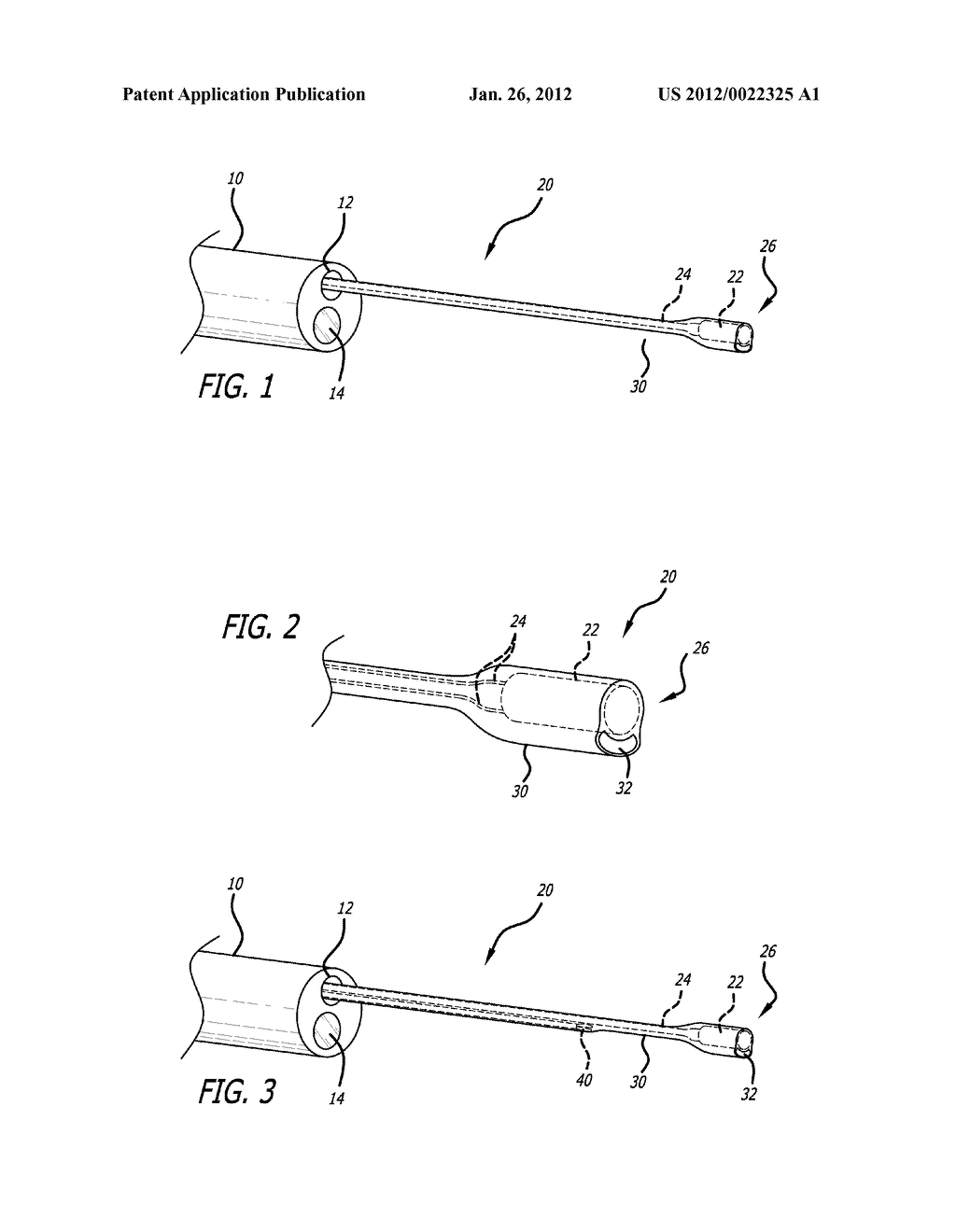 Locatable Expandable Working Channel And Method - diagram, schematic, and image 02