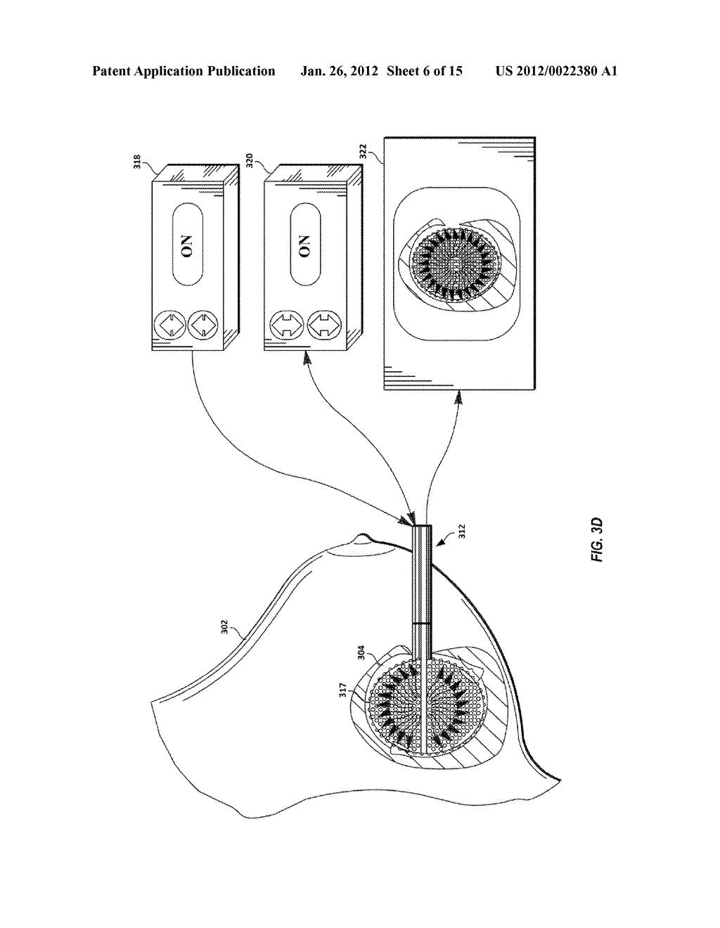 METHODS AND APPARATUS FOR ASSESMENT AND TREATMENT OF BODY CAVITIES - diagram, schematic, and image 07