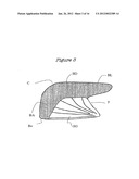 Method and Device for the Treatment of Obstructive Sleep Apnea and Snoring diagram and image