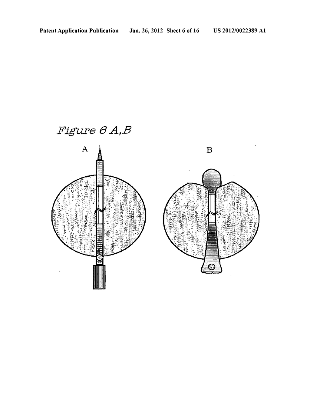 Method and Device for the Treatment of Obstructive Sleep Apnea and Snoring - diagram, schematic, and image 07