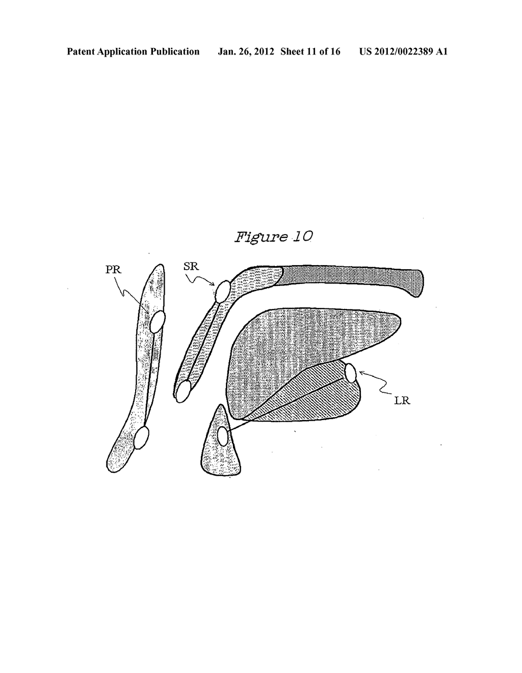 Method and Device for the Treatment of Obstructive Sleep Apnea and Snoring - diagram, schematic, and image 12