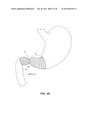 SATIATION DEVICES AND METHODS diagram and image